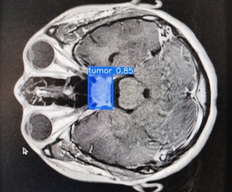 CNN for early tumor detection